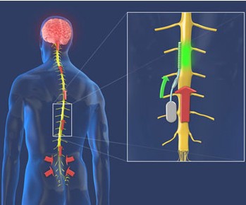 Stworzyli implant leczcy bl krgosupa