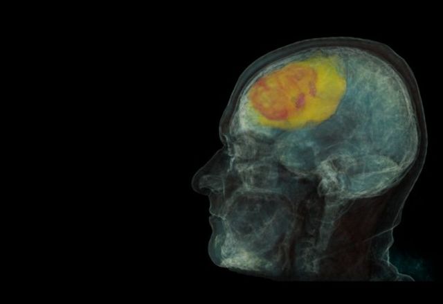 Microsoft pomoe wykry raka w 30 sekund